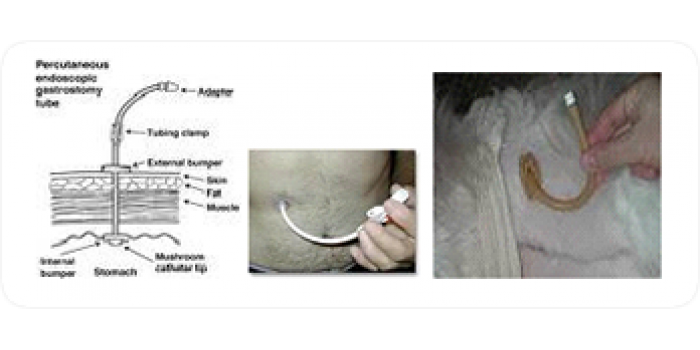 Perkütan Endoskopik Gastrostomi (PEG) 