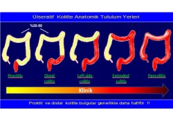 İNFLAMATUVAR BAĞIRSAK HASTALIKLARI (İBH) [ÜlseratifKolit (ÜK) & Crohn Hastalığı (CH)]