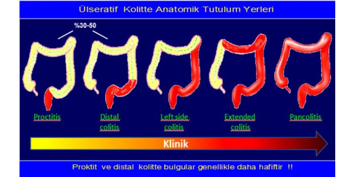 İNFLAMATUVAR BAĞIRSAK HASTALIKLARI (İBH) [ÜlseratifKolit (ÜK) & Crohn Hastalığı (CH)]