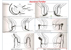 ANOREKTAL ABSE VE FİSTÜL