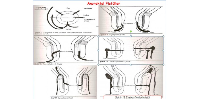 ANOREKTAL ABSE VE FİSTÜL