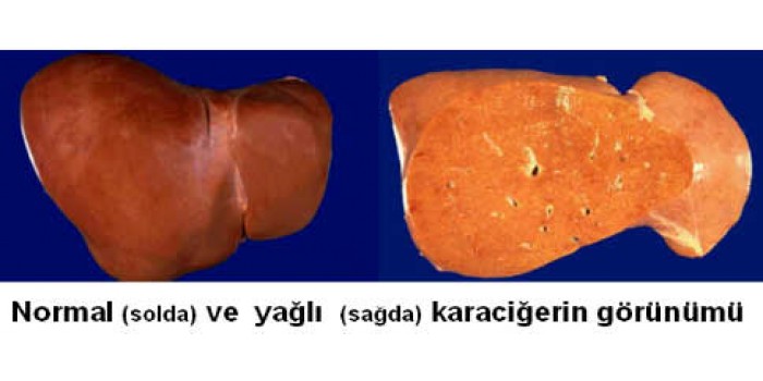 Karaciğer Yağlanması