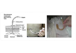 Perkütan Endoskopik Gastrostomi (PEG) 