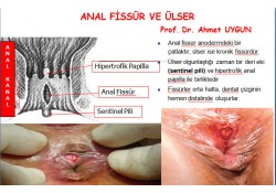 ANAL FİSSÜR VE ÜLSER