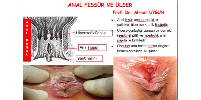 ANAL FİSSÜR VE ÜLSER